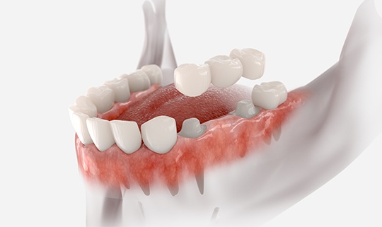 Digital illustration of a dental bridge