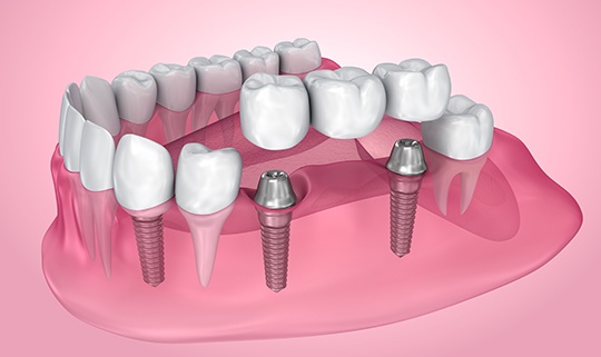 Digital illustration of an implant bridge