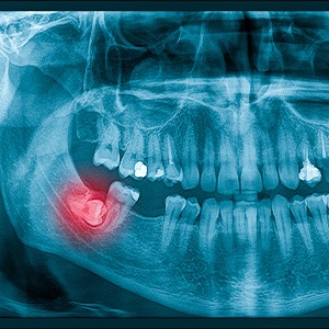 Factors that can affect the cost of tooth extractions include number of teeth and tooth placement in Attleboro, MA 