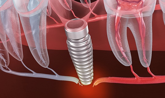 Illustration of a failed dental implant in Attleboro, MA