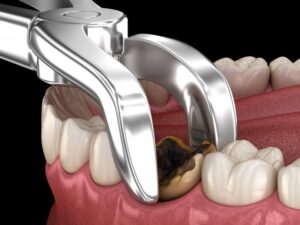 illustration of pliers extracting a badly decayed tooth